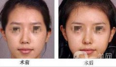 自體脂肪豐太陽穴多久消腫