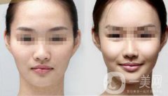 杭州自體脂肪豐蘋果肌多少錢