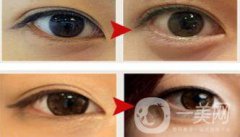 玻尿酸豐臥蠶術(shù)后護(hù)理怎么做