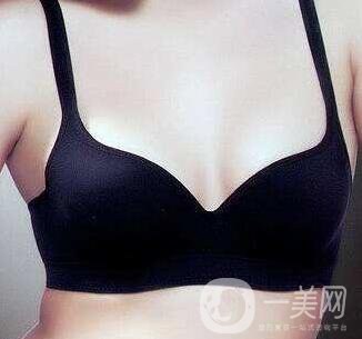 副乳切除術(shù)有后遺癥嗎？
