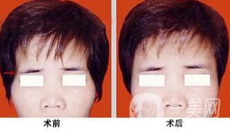 玻尿酸豐太陽穴術(shù)后護理注意事項有哪些