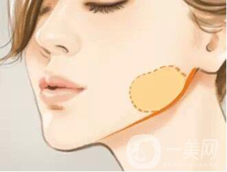 去頰脂墊瘦臉多少錢？