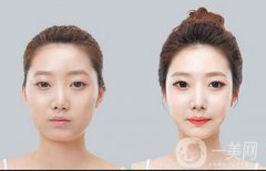 自體脂肪豐太陽穴果能維持多久？