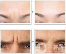 上海玻尿酸去眉間紋多少錢