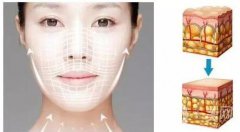 成都做一次熱瑪吉需要多少錢呢?注意事項有哪些?