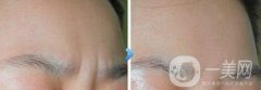 *去眉間紋維持時間是多長