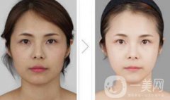 光纖溶脂好不好？價(jià)格是多少