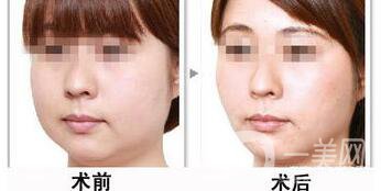 光纖溶脂好不好？?jī)r(jià)格是多少