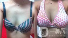 隆胸的危害有哪些 如何避免隆胸失敗