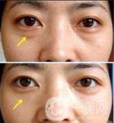 北京溶脂去眼袋價(jià)格是多少