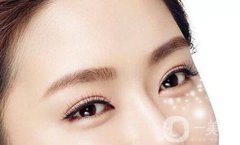 北京自體豐臥蠶多少錢?注意事項(xiàng)有哪些?