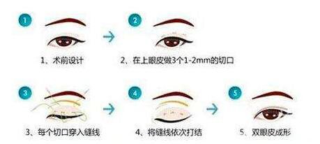 割雙眼皮埋線過程圖,埋線雙眼皮注意事項
