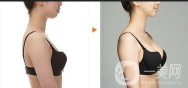 北京內(nèi)窺鏡假體豐胸價(jià)格,內(nèi)窺鏡假體豐胸*果
