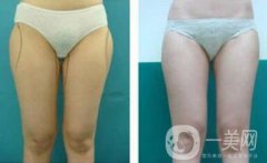 光纖溶脂瘦大腿會反彈嗎？術后注意事項介紹