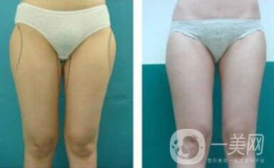 光纖溶脂瘦大腿會反彈嗎？術后注意事項介紹