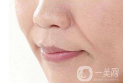 手術去法令紋果*維持嗎