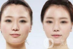 面部光纖溶脂好嗎？?jī)r(jià)格是多少