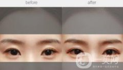 北京現(xiàn)在割雙眼皮多少錢