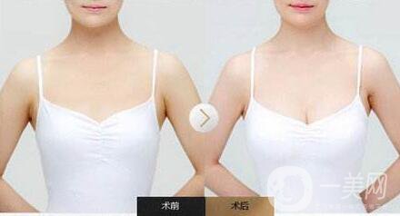 隆胸后怎么護(hù)理？術(shù)前怎么準(zhǔn)備？