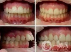 上海天包地牙齒矯正費用是多少