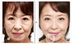 汕頭電波拉皮除皺多少錢