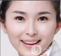 玻尿酸豐蘋果肌術(shù)后多久果自然