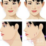 怎么去掉雙下巴？溶脂去雙下巴怎么樣
