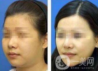 怎么去掉雙下巴？溶脂去雙下巴怎么樣