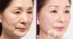 拉皮除皺能堅(jiān)持幾年？與哪些因素有關(guān)？