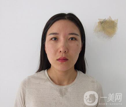 全開雙眼皮和開眼角