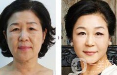 拉皮能維持多久？拉皮的價格是多少