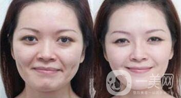拉皮能維持多久？拉皮的價格是多少
