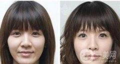 自體脂肪去法令紋果怎么樣