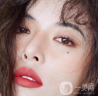玻尿酸去眉間紋多少錢及術(shù)后護理