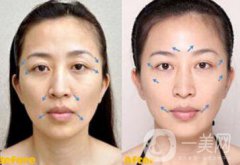 熱瑪吉副作用有哪些 如何避免副作用