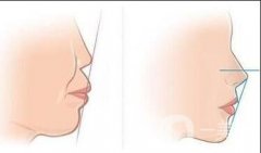 上海做正頜手術(shù)多少錢？術(shù)后護(hù)理方法有哪些？