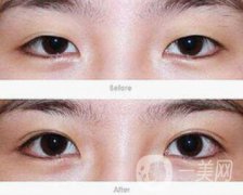 韓式開眼角哪果好?韓式開眼角醫(yī)院信息介紹
