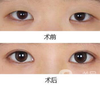 韓式開(kāi)眼角哪*果好?韓式開(kāi)眼角醫(yī)院信息介紹