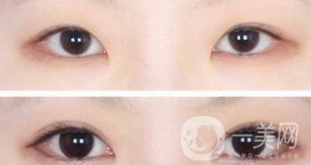 韓式開(kāi)眼角哪*果好?韓式開(kāi)眼角醫(yī)院信息介紹