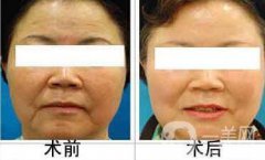 江蘇微波拉皮價(jià)格是多少