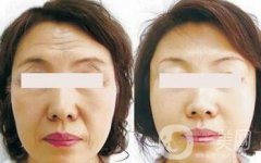 電波拉皮果怎么樣呢？價格高嗎