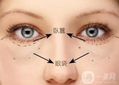 深圳臥蠶整形價(jià)格是多少？