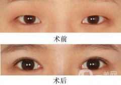 三點(diǎn)定位割雙眼皮多久恢復(fù)