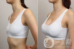 假體豐胸需要恢復(fù)多久