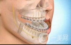 深圳牙齒地包天矯正價格一般是多少呢？