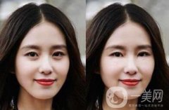 自體脂肪豐臥蠶術(shù)后護(hù)理主要有些什么注意事項(xiàng)