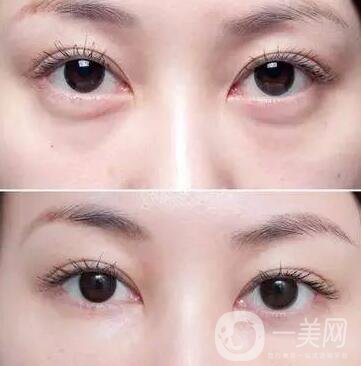 玻尿酸填充淚溝注意事項
