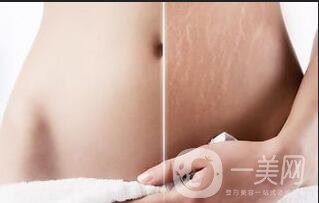 去妊娠紋