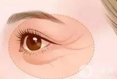 眼周年輕化手術注意事項一般有哪些？