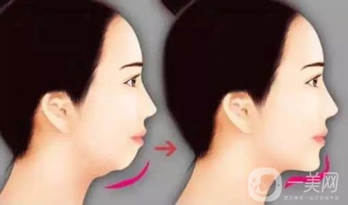 膨體墊下巴有沒有后遺癥？有些什么后遺癥